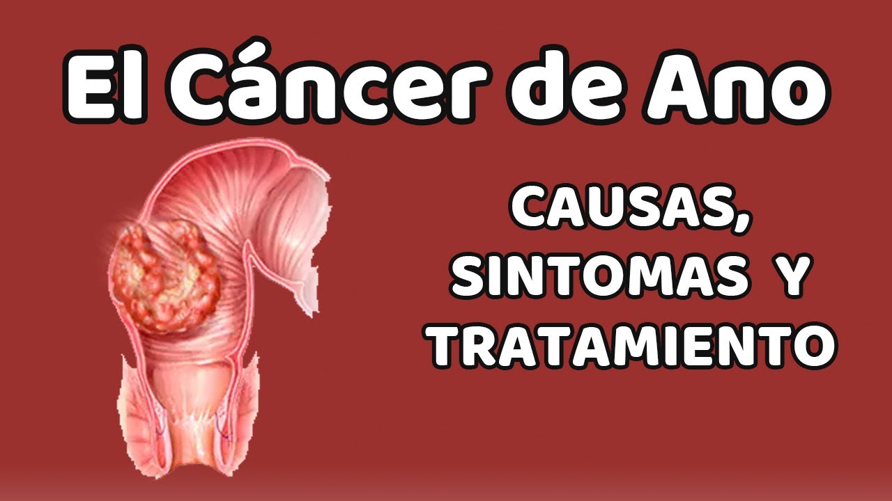 EL CÁNCER DE ANO, Causas, signos y síntomas, diagnóstico y tratamiento