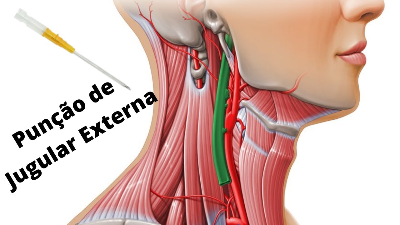 Tudo sobre Punção de Jugular