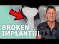 Can dental implants break? - Don’t let this happen to you! • Part 2 of 2