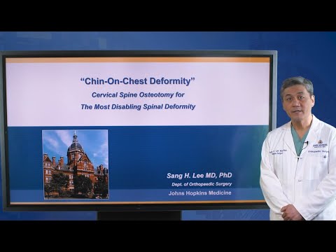 Cervical Spine Osteotomy for Chin-on-Chest Deformity
