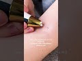 MY EXPERIENCE REMOVING SKIN TAGS AT HOME VS CLINIC Shorts