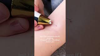 MY EXPERIENCE REMOVING SKIN TAGS AT HOME VS CLINIC #shorts
