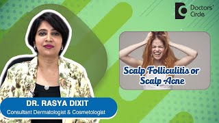 ACNE OR PIMPLES ON SCALP | Scalp Folliculitis - Causes & Treatment- Dr.Rasya Dixit | Doctors