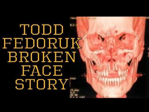 How Todd Fedoruk Completely Broke His Face Fighting In The NHL