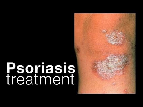 Psoriasis: treatment options + related issues