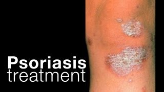 Psoriasis: treatment options + related issues
