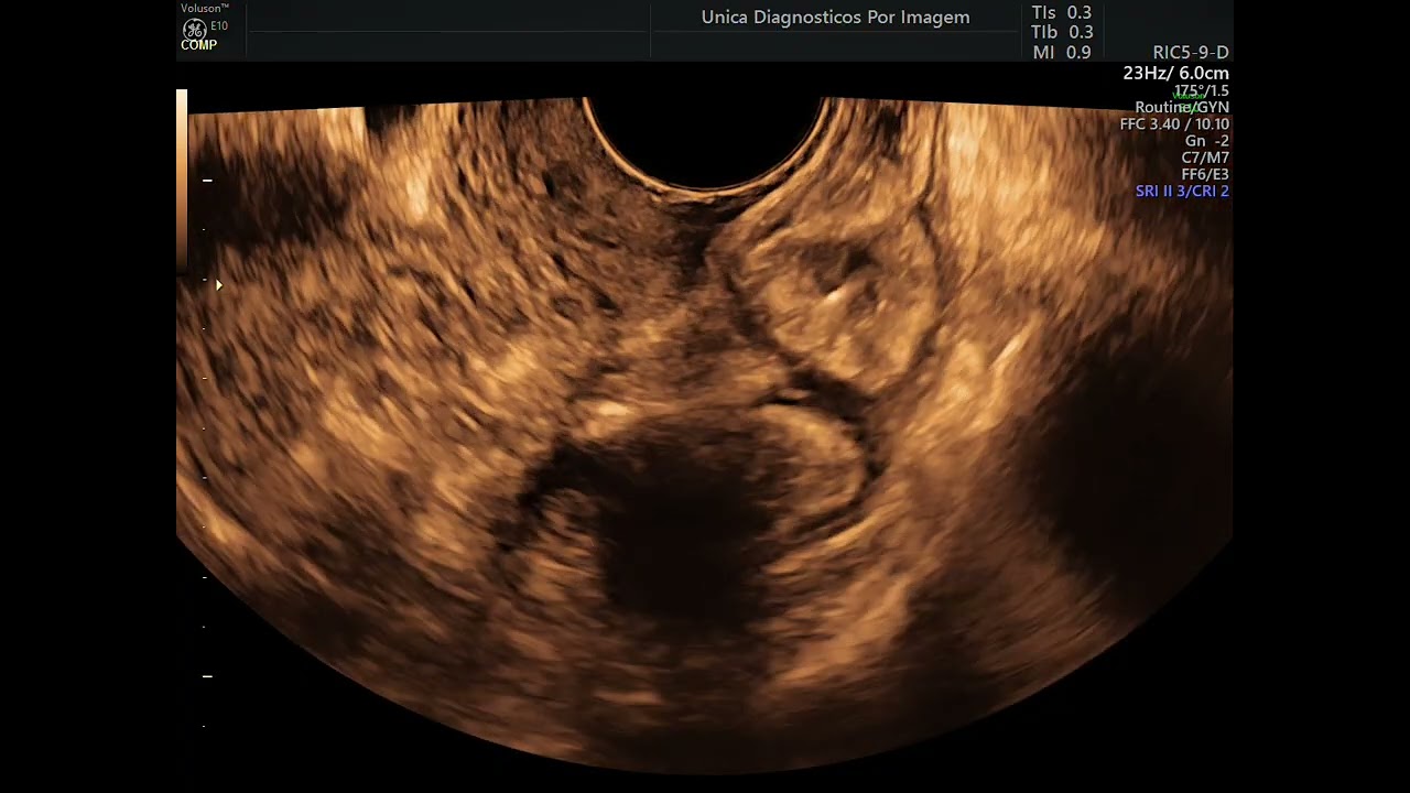 Mapeamento de endometriose com preparo intestinal