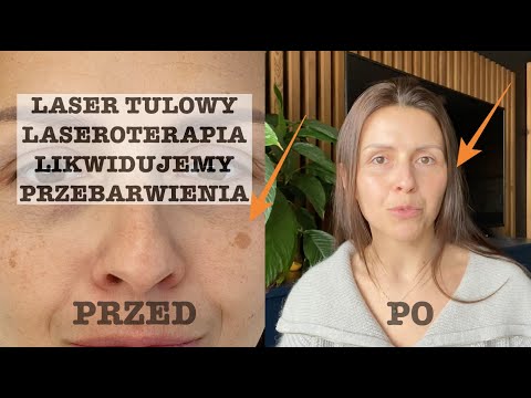 LASER TULOWY / REDUKCJA PRZEBARWIEŃ / PRZED I PO