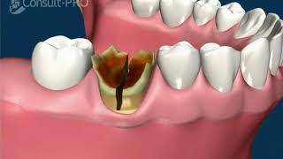Extraction: Severe Crown Destruction, Tooth Section | Implants Pro Center© | San Francisco