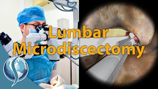 Download lagu Lumbar Microdiscectomy mp3 Download lagu Lumbar Microdiscectomy mp3