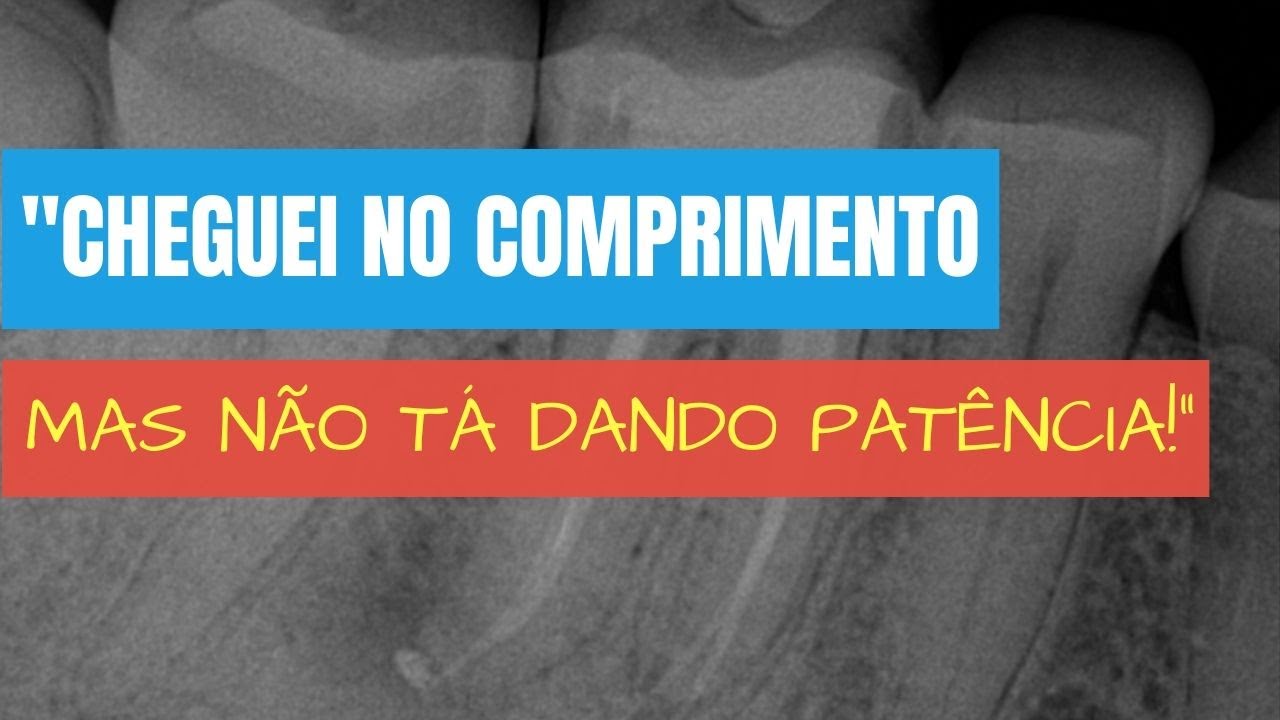 SAIBA ISSO ANTES DE GASTAR UMA DÚZIA DE LIMAS A MAIS TENTANDO DAR PATÊNCIA - ENDOLOVERS QUICK TIPS