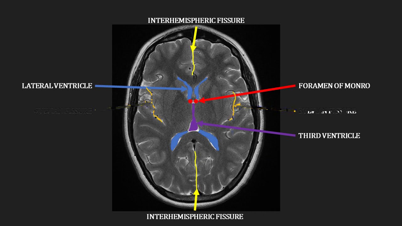 Introduction to MRI of the brain