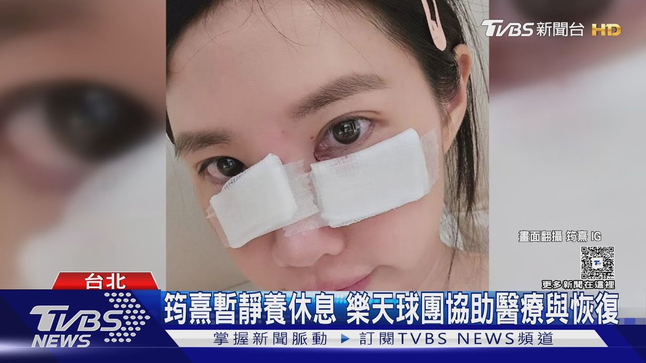 樂天女孩筠熹破相!遭愛犬咬傷臉部「傷勢照」曝光 與球迷告假