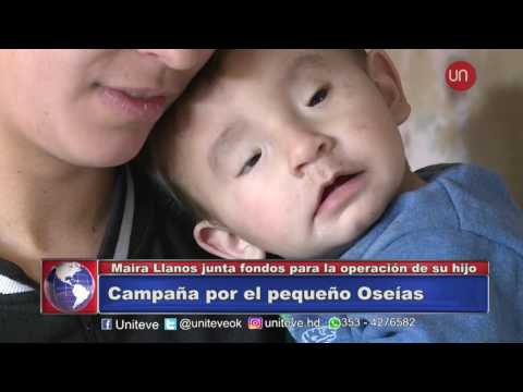 Síndrome de Párpados Caídos