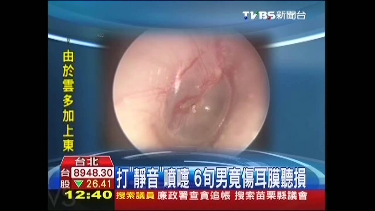 打「靜音」噴嚏 6旬男竟傷耳膜聽損