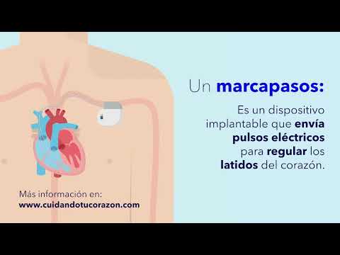¿Qué es un marcapasos y cómo funciona?