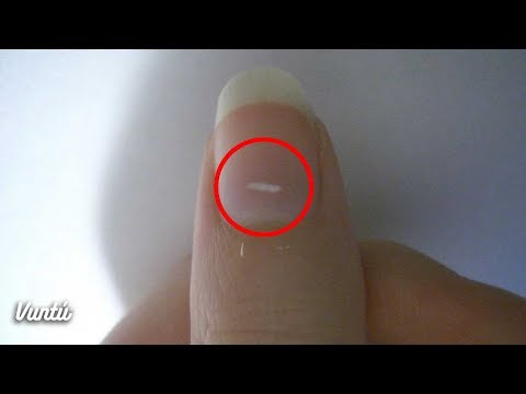 Estas son las verdaderas causas de las manchas blancas en las uñas Estas son las verdaderas causas de las manchas blancas en las uñas