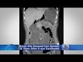 Braces Wire Removed From Woman S Stomach 10 Years After Swallowing It
