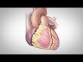 Coronary Artery Bypass Surgery