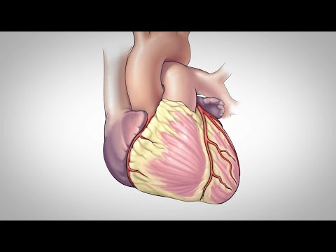 Coronary Artery Bypass Surgery