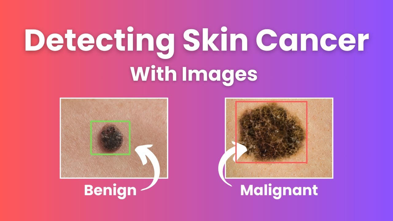 Melanoma Detection Model from Scratch in 4 Minutes