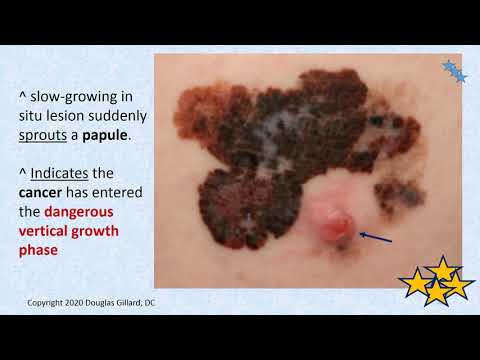 image-Is lentigo cancerous?