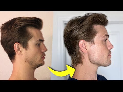 How I Fixed My Receding Chin