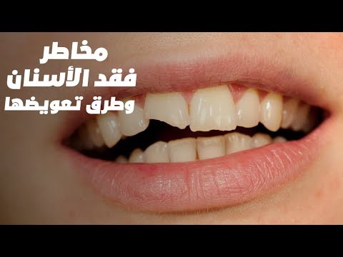 اعرف مخاطر فقد الأسنان وطرق تعويضها مع دكتور شادى على حسين