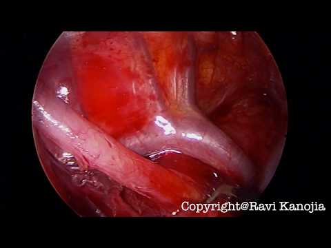 Thoracoscopic Repair of Esophageal Atresia (Unedited Video)