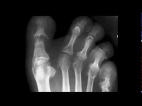 Umflarea durerii articulare la încheietura mâinii