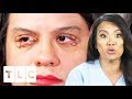Dr. Lee Removes Numerous Cysts From Woman's Eyelids | Dr. Pimple Popper