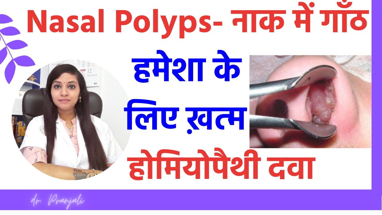 Nasal polyps treatment | homeopathy for nasal polyps | nasal polyps homeopathic medicines
