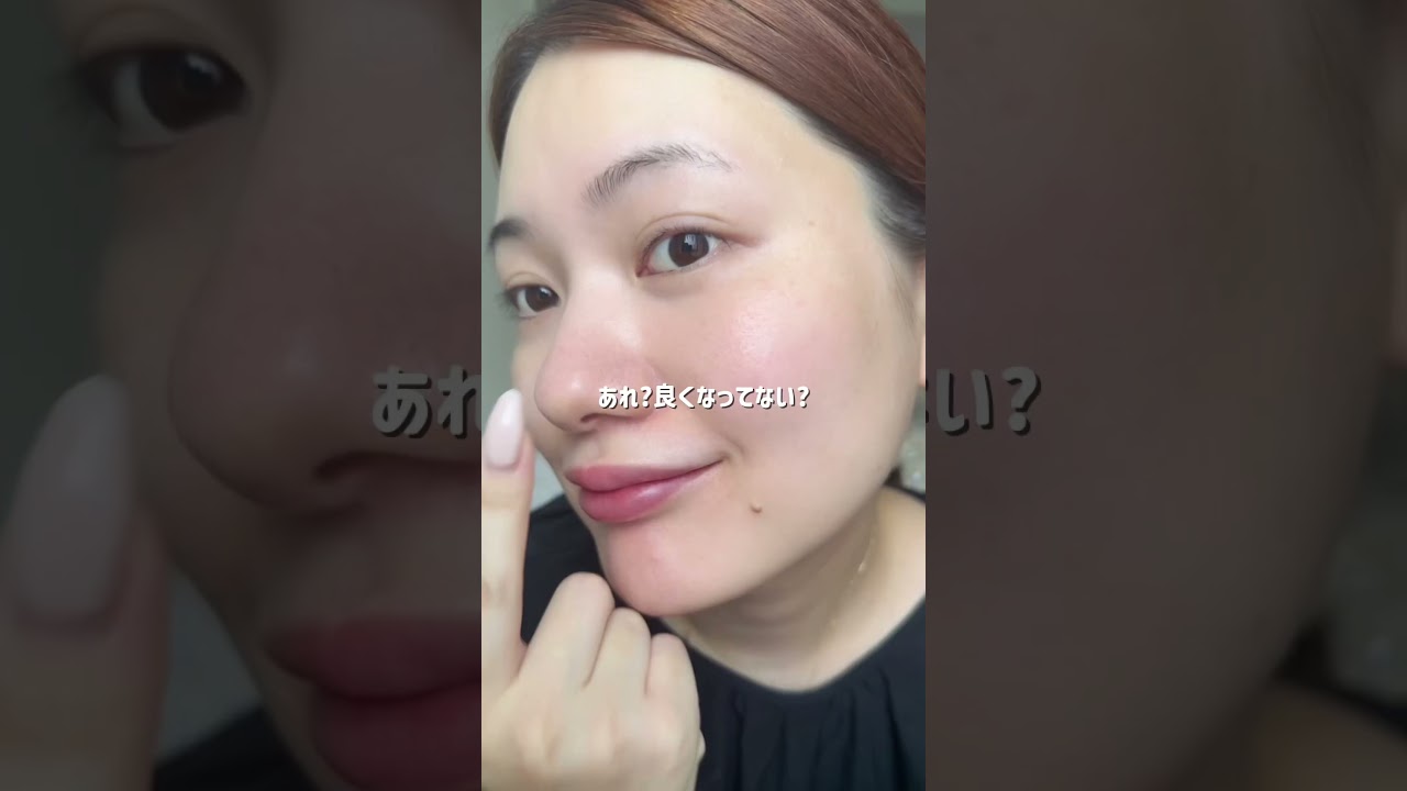 カタン10番使ってからみるみる肌が剥け卵みたいにつるんとしてきて、気になってたシミそばかすがこの通り😢✨#カタン10番 #katanニードル #カタンダーマヒットセラム10番 #毛穴レス #PR