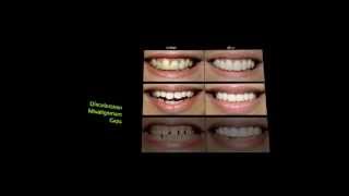 Mooie witte tanden dankzij GlamSmile - Un beau sourire grâce à GlamSmile