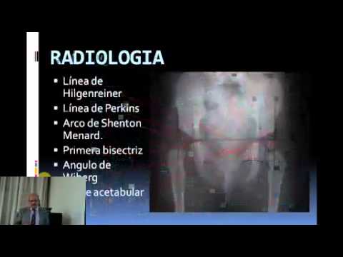Osteocondrosis reduce la mano Cómo y por qué cura el dolor en el lado izquierdo del cuello