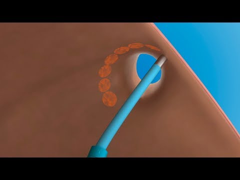 Vorhofflimmern: Wie funktioniert eine Katheterablation?