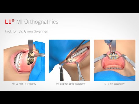 L1® MI Orthognathics (English)