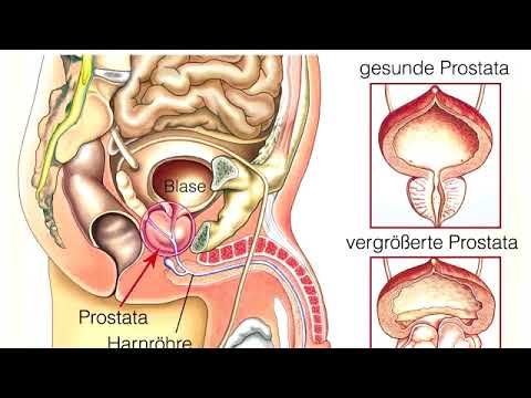 Was ist gefährlich Stagnation in der Prostata Männer Prostatakrebs kann mit ihm Sex haben