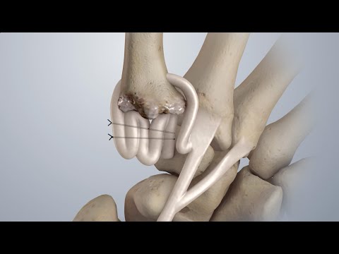 Osteoarthritis of the Thumb: Surgical Treatment (LRTI)