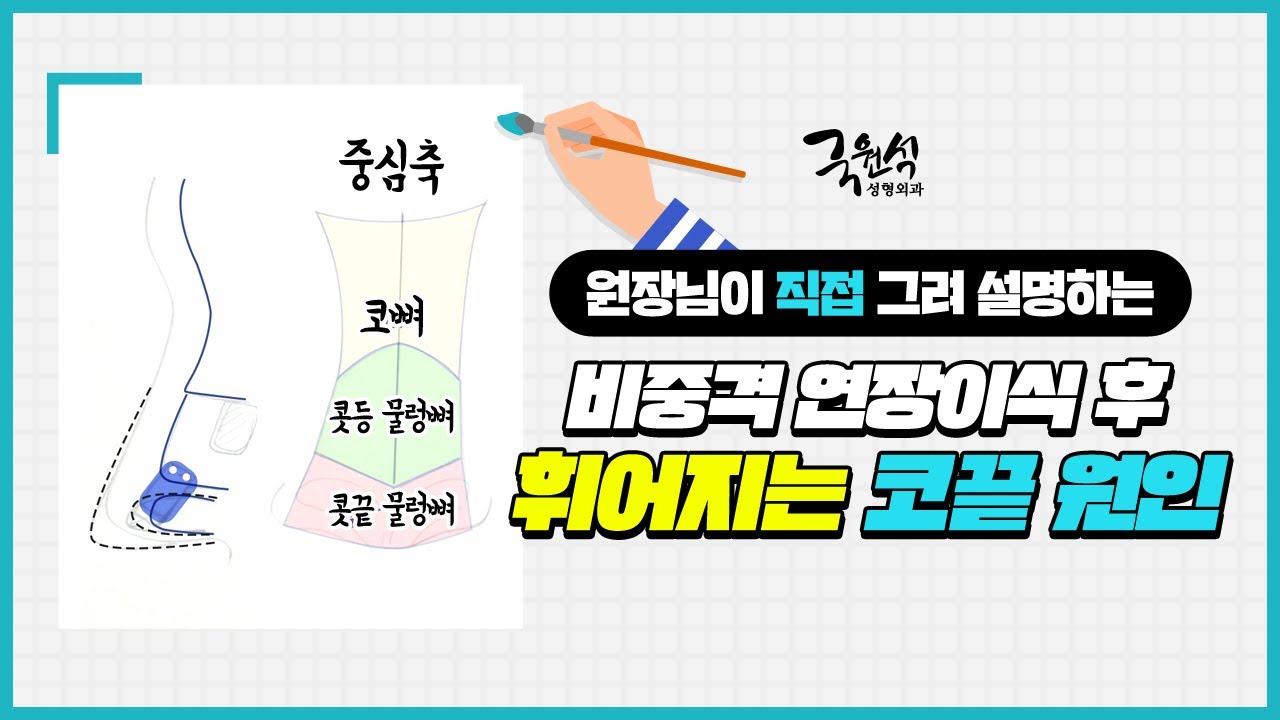 비중격 연장 이식 후 코끝이 휘어지는 현상 #비중격연장이식 #비중격연장이식부작용 썸네일