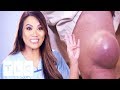 Dr. Sandra Lee Faces Her Biggest Cyst Yet! | Dr. Pimple Popper
