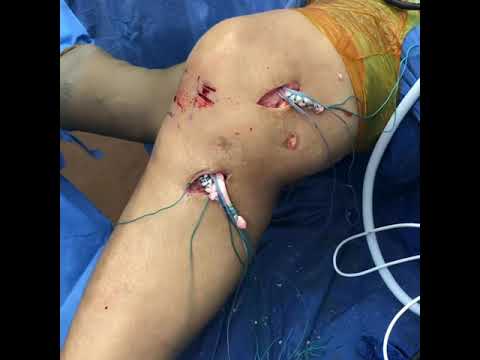 Multiligament knee surgery (ACL + PCL + MCL complete tears) Live video at end of procedure