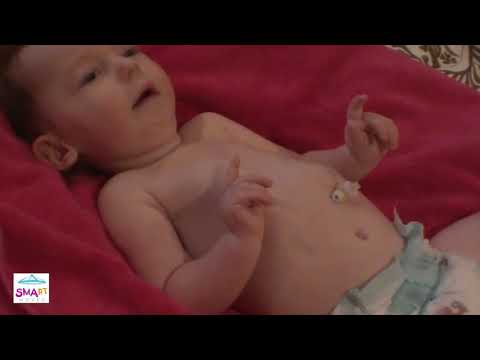 Learn to Spot the Warning Signs of SMA – Belly Breathing and Bell-Shaped Chest (Video 1)