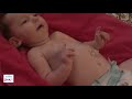 Learn To Spot The Warning Signs Of SMA Belly Breathing And Bell Shaped Chest Video 1