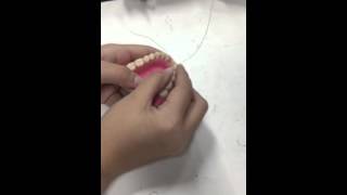 Periodontal Splinting (Continuous)