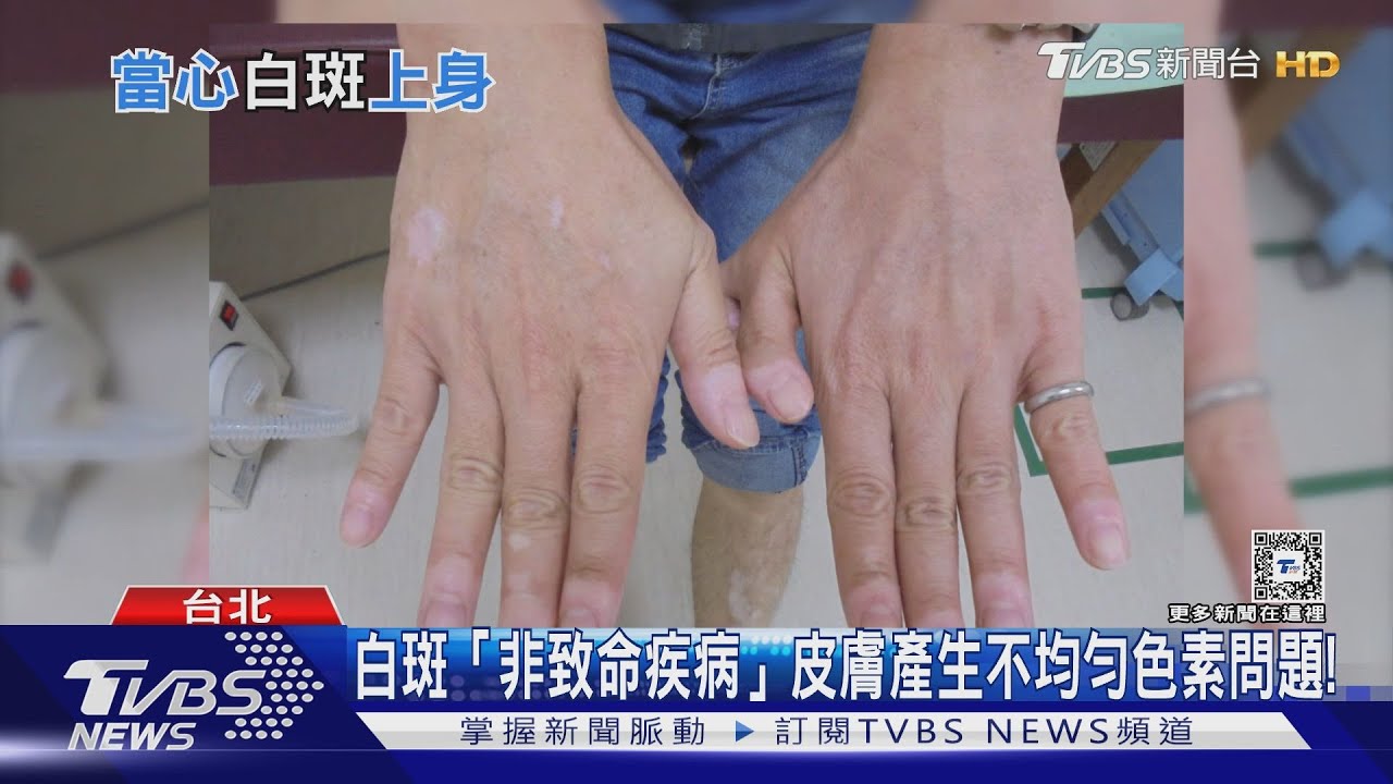皮膚出現「這顏色」不只帶來社交困擾 醫師:自體免疫攻擊易發生「這疾病」