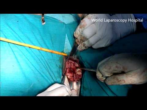 Bisection of Uterus in Vaginal Hysterectomy