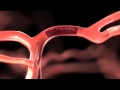 Stroke Acute Stroke Intervention