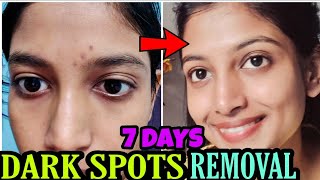 Real Experience 😍 Dark Spots Treatment Naturally at home