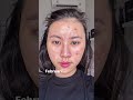 Beginilah Kalau Punya Kulit Acne Prone Skin